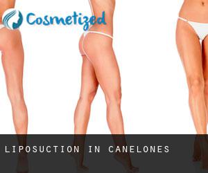 Liposuction in Canelones