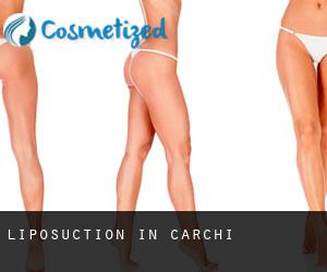 Liposuction in Carchi