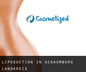 Liposuction in Schaumburg Landkreis