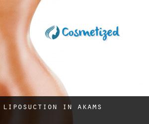 Liposuction in Akams