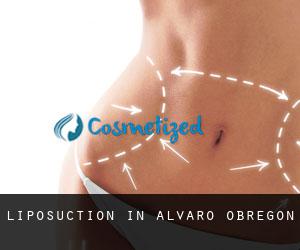 Liposuction in Alvaro Obregón