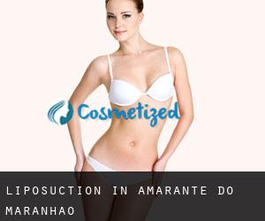 Liposuction in Amarante do Maranhão