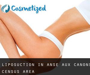 Liposuction in Anse-aux-Canons (census area)