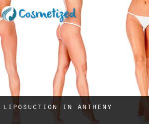 Liposuction in Antheny