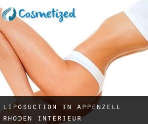 Liposuction in Appenzell Rhoden-Intérieur