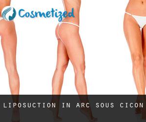 Liposuction in Arc-sous-Cicon