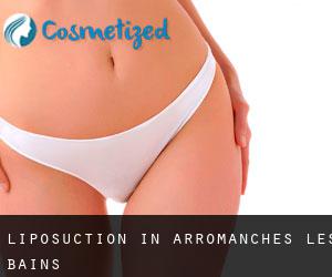 Liposuction in Arromanches-les-Bains