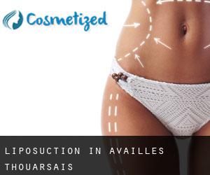 Liposuction in Availles-Thouarsais