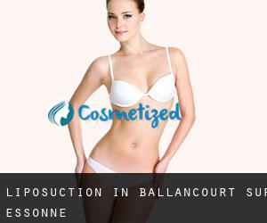 Liposuction in Ballancourt-sur-Essonne