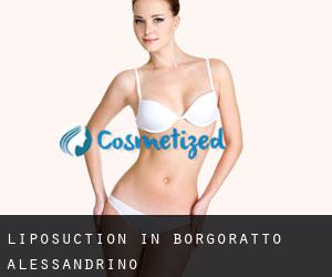 Liposuction in Borgoratto Alessandrino
