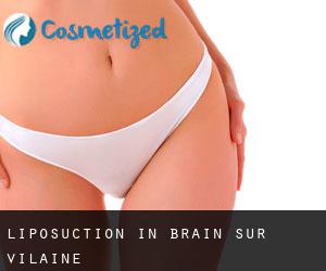Liposuction in Brain-sur-Vilaine