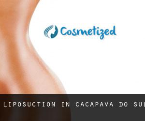 Liposuction in Caçapava do Sul