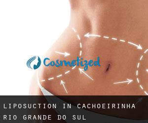 Liposuction in Cachoeirinha (Rio Grande do Sul)