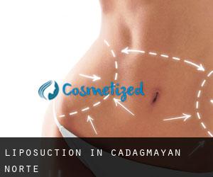 Liposuction in Cadagmayan Norte