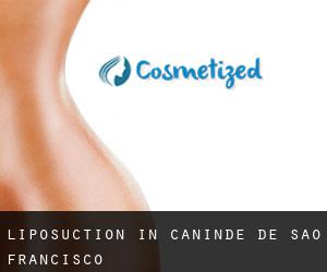 Liposuction in Canindé de São Francisco