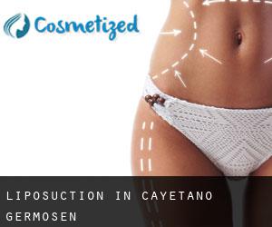 Liposuction in Cayetano Germosén