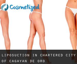 Liposuction in Chartered City of Cagayan de Oro