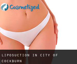 Liposuction in City of Cockburn