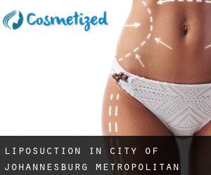 Liposuction in City of Johannesburg Metropolitan Municipality