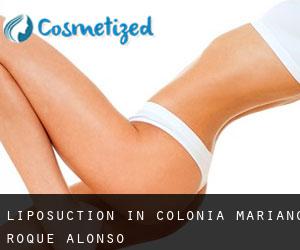 Liposuction in Colonia Mariano Roque Alonso