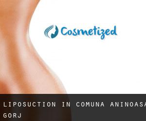 Liposuction in Comuna Aninoasa (Gorj)
