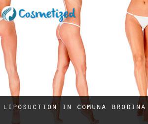 Liposuction in Comuna Brodina