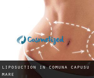 Liposuction in Comuna Cãpuşu Mare