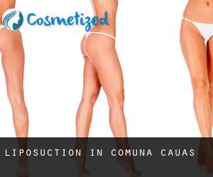 Liposuction in Comuna Căuaş