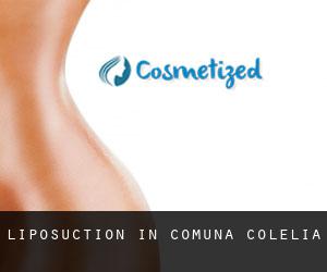 Liposuction in Comuna Colelia