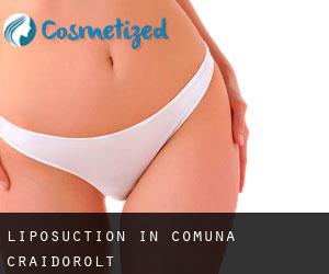 Liposuction in Comuna Craidorolţ