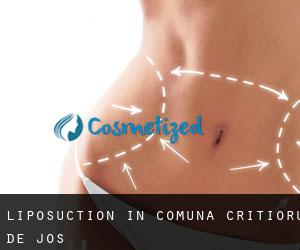 Liposuction in Comuna Criștioru de Jos