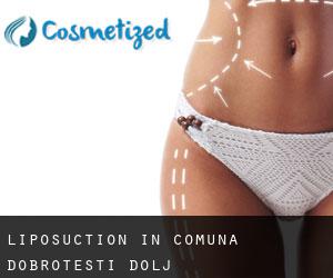 Liposuction in Comuna Dobroteşti (Dolj)