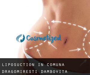 Liposuction in Comuna Dragomireşti (Dâmboviţa)