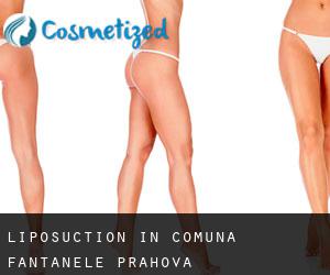 Liposuction in Comuna Fântânele (Prahova)