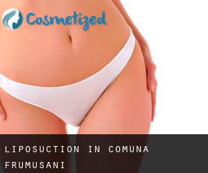 Liposuction in Comuna Frumuşani