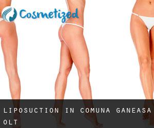 Liposuction in Comuna Găneasa (Olt)