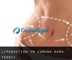 Liposuction in Comuna Gura Teghii