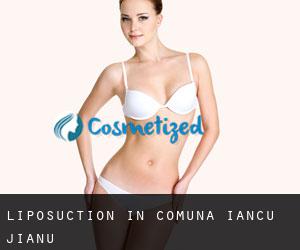 Liposuction in Comuna Iancu Jianu