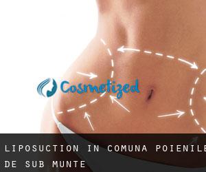 Liposuction in Comuna Poienile de sub Munte