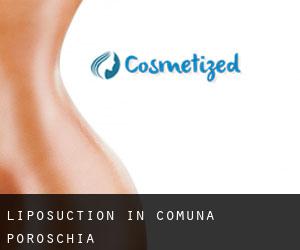 Liposuction in Comuna Poroschia