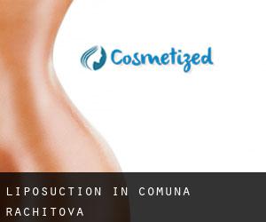 Liposuction in Comuna Răchitova