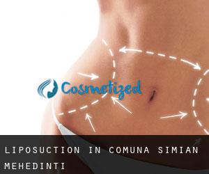 Liposuction in Comuna Simian (Mehedinţi)