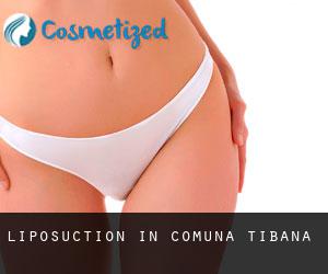 Liposuction in Comuna Ţibana