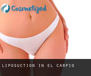 Liposuction in El Carpio