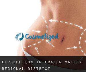 Liposuction in Fraser Valley Regional District
