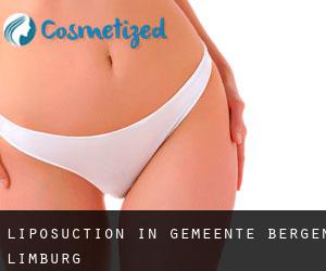 Liposuction in Gemeente Bergen (Limburg)