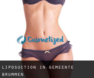 Liposuction in Gemeente Brummen