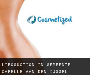 Liposuction in Gemeente Capelle aan den IJssel