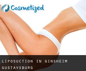 Liposuction in Ginsheim-Gustavsburg