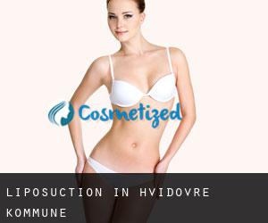 Liposuction in Hvidovre Kommune